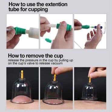 komplet za nokte: Ventuze . CUPPING-fizikalna terapija-akupunktura- čašama Komplet za — 12